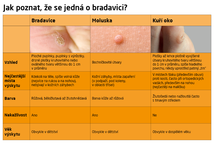Jak se pozná bradavice?